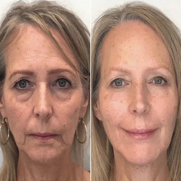 SkinLift™ | Botox Gezicht Serum Magic